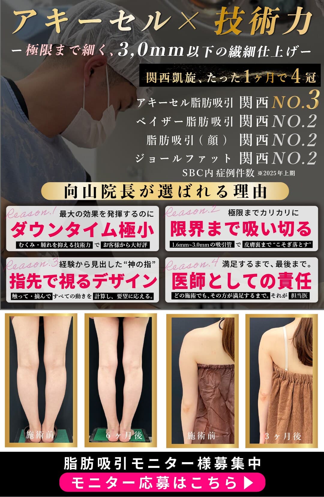 向山院長 脂肪吸引モニターページを確認する